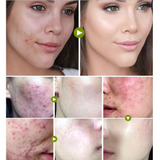 glamour tea tree cream